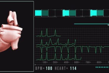 Rehabilitacja kardiologiczna po stentach – Co musisz wiedzieć?