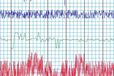 Prawogram w EKG: znaczenie, diagnostyka i interpretacja