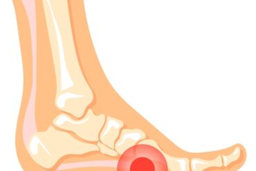 Wzdęty brzuch: Objawy, Przyczyny i Jak Sobie Pomóc
