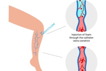 EKG – Co to jest, jak działa i jakie ma znaczenie?